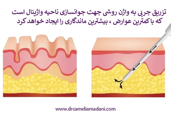 تزریق چربی واژن _ دکتر کاملیا مدنی