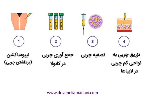 تزریق چربی به واژن در همدان _ دکتر کاملیا مدنی