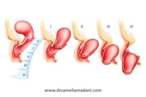 مراحل مختلف افتادگی رحم _ دکتر کاملیا مدنی