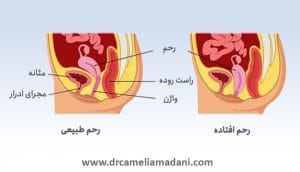 عارضه افتادگی رحم در زنان _ دکتر کاملیا مدنی