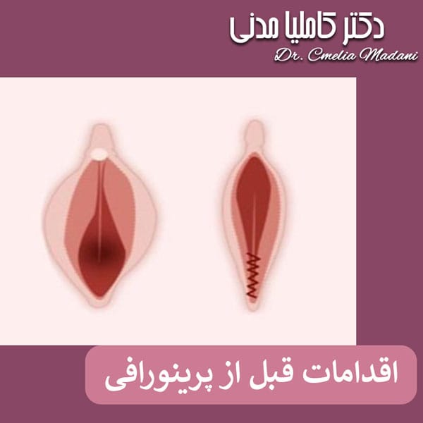 اقدامات قبل از پرینورافی - دکتر کاملیا مدنی