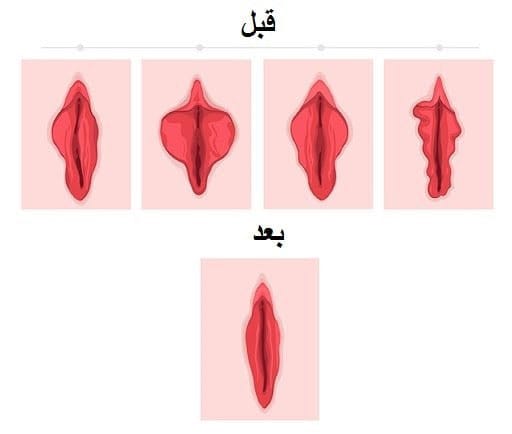 قبل و بعد لابیاپلاستی - دکتر کاملیا مدنی