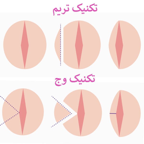 تکنیک های لابیاپلاستی وج و تریم - دکتر کاملیا مدنی
