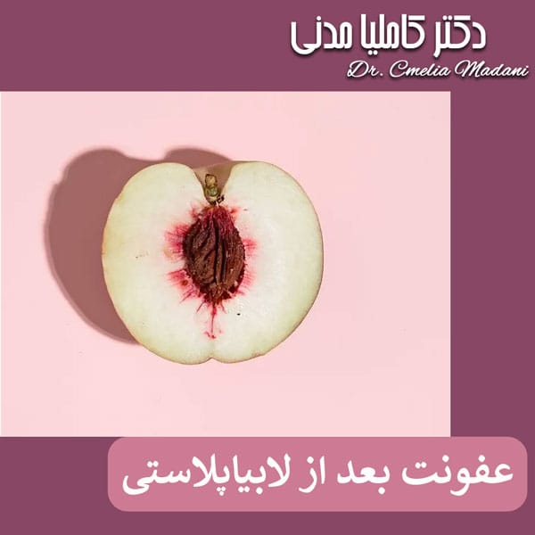 عفونت بعد از لابیاپلاستی در همدان - دکتر کاملیا مدنی