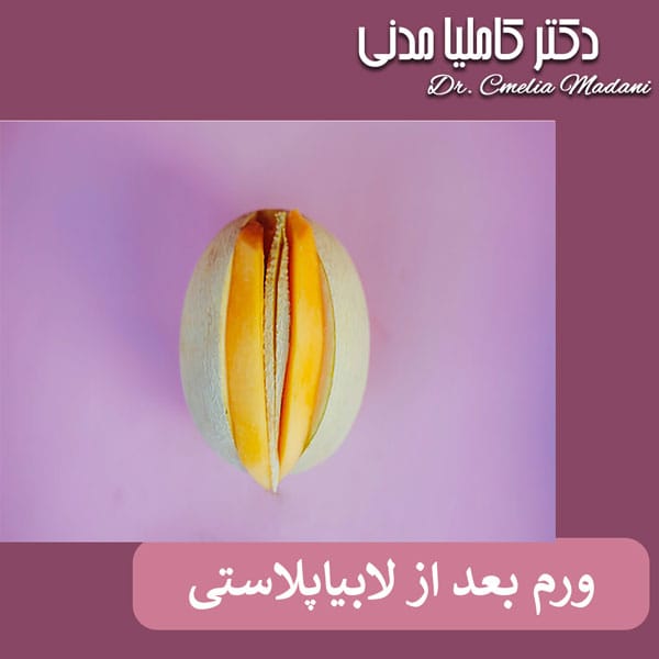 ورم بعد از لابیاپلاستی - دکتر کاملیا مدنی