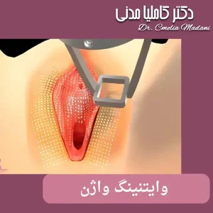 سفید کردن واژن با وایتنینگ در همدان _ دکتر کاملیا مدنی 