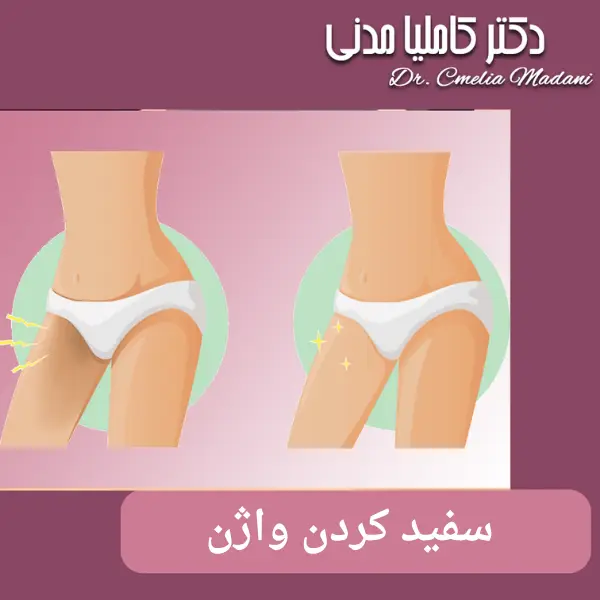واژینال وایتنینگ _ دکتر کاملیا مدنی