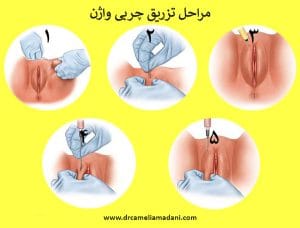 ماندگاری تزریق چربی واژن _ دکتر کاملیا مدنی 