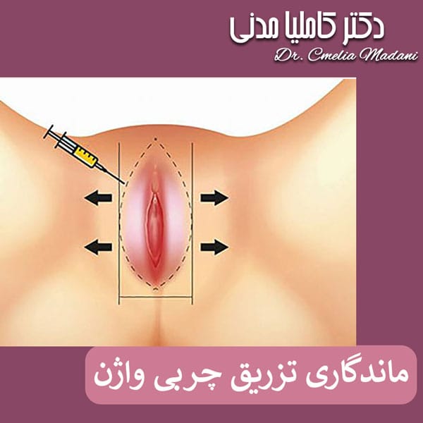 ماندگاری تزریق چربی واژن _ دکتر کاملیا مدنی