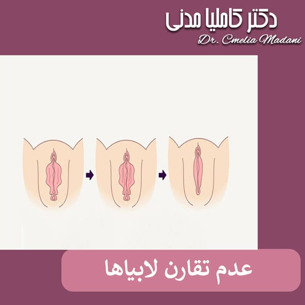 عدم تقارن لابیاها بعد از لابیاپلاستی _ دکتر کاملیا مدنی