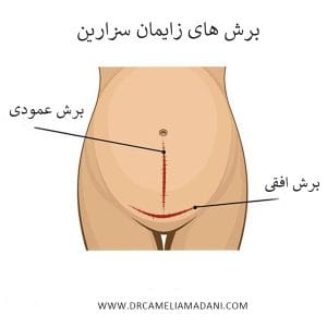 عکس برش زایمان سزارین _ دکتر کاملیا مدنی