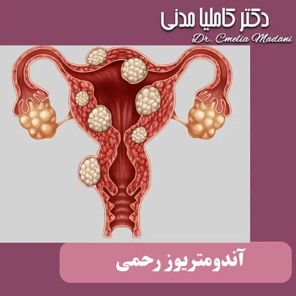 آندومتریوز رحمی _ دکتر کاملیا مدنی