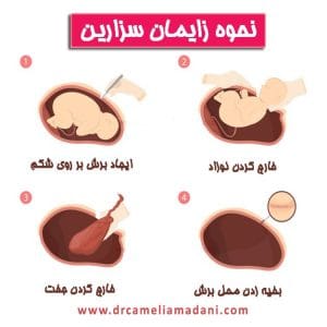 مراحل زایمان سزارین _ دکتر کاملیا مدنی