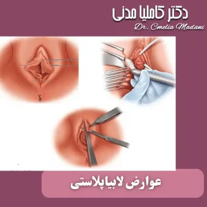 عوارض لابیاپلاستی _ دکتر کاملیا مدنی