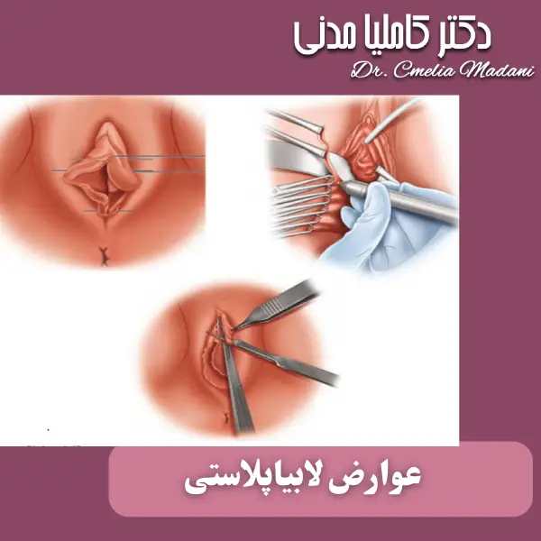 عوارض لابیاپلاستی _ دکتر کاملیا مدنی