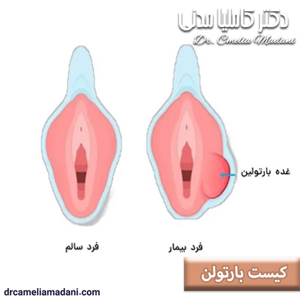 کیست بارتولن