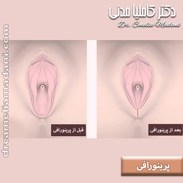 قبل و بعد از پرینورافی در همدان - دکتر کاملیا مدنی