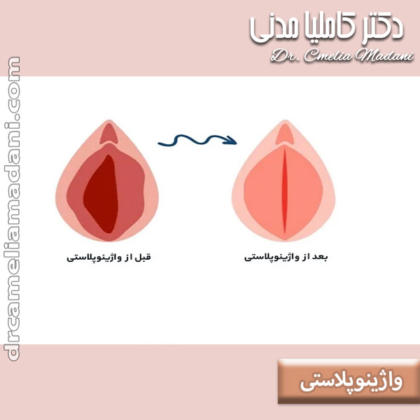 واژینوپلاستی