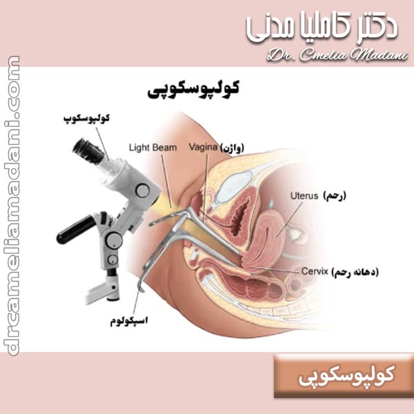 کولپوسکوپی